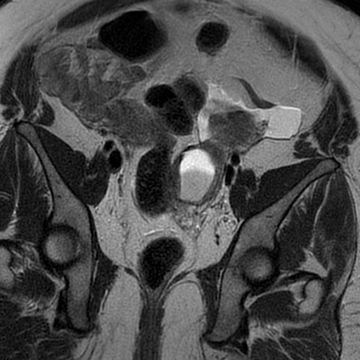 File:Adenomyosis within a didelphys uterus (Radiopaedia 70175-80215 Coronal T2 19).jpg