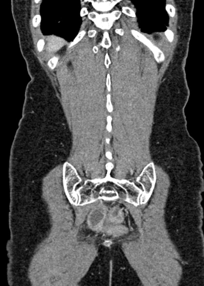 Adhesional small bowel obstruction (Radiopaedia 48397-53305 Coronal C+ portal venous phase 303).jpg