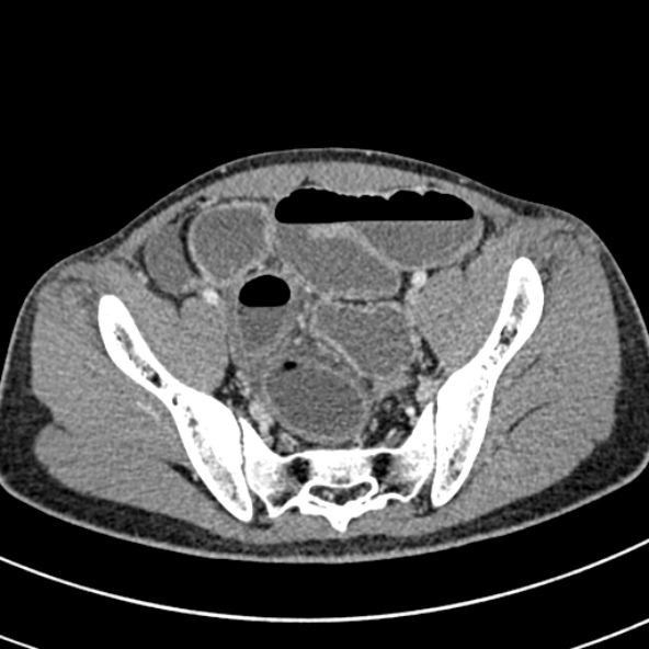 Adhesional small bowel obstruction (Radiopaedia 52107-57980 Axial C+ portal venous phase 103).jpg