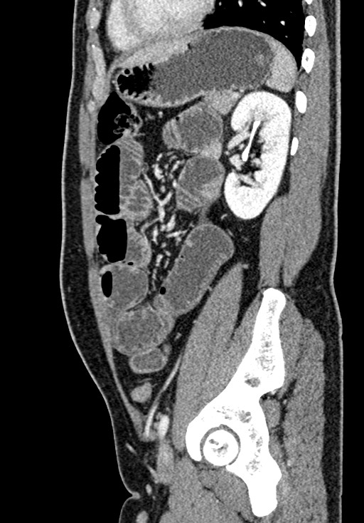 Adhesional small bowel obstruction (Radiopaedia 58900-66131 Sagittal C+ portal venous phase 176).jpg