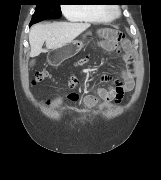 Adhesions within abdominal wall hernia (Radiopaedia 58283-65394 Coronal C+ portal venous phase 22).png
