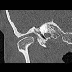 File:Adhesive chronic otitis media (Radiopaedia 14270-14148 Coronal bone window - right 4).jpg