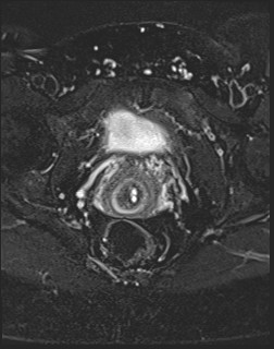 File:Adnexal multilocular cyst (O-RADS US 3- O-RADS MRI 3) (Radiopaedia 87426-103754 Axial T2 fat sat 19).jpg