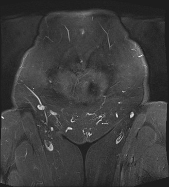File:Adnexal multilocular cyst (O-RADS US 3- O-RADS MRI 3) (Radiopaedia 87426-103754 Coronal T2 fat sat 2).jpg