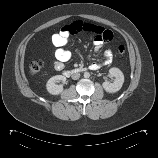 Adrenal cyst (Radiopaedia 45625-49776 Axial C+ portal venous phase 45).png