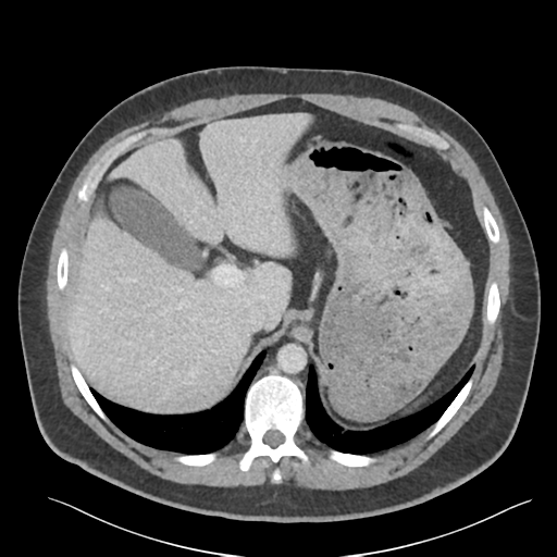 File:Adrenal cyst (Radiopaedia 45625-49777 Axial C+ portal venous phase 27).png