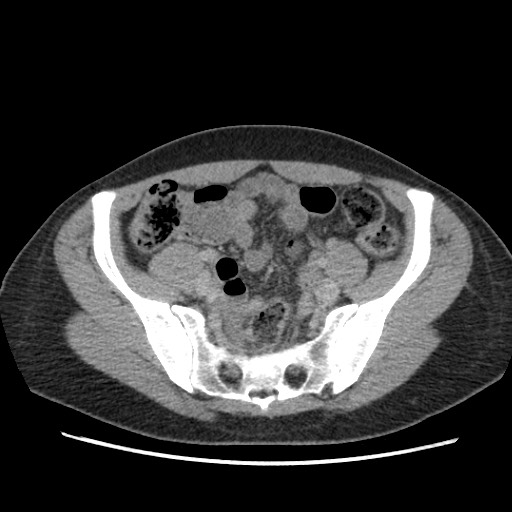 File:Adrenal cyst (Radiopaedia 64869-73813 Axial C+ portal venous phase 60).jpg