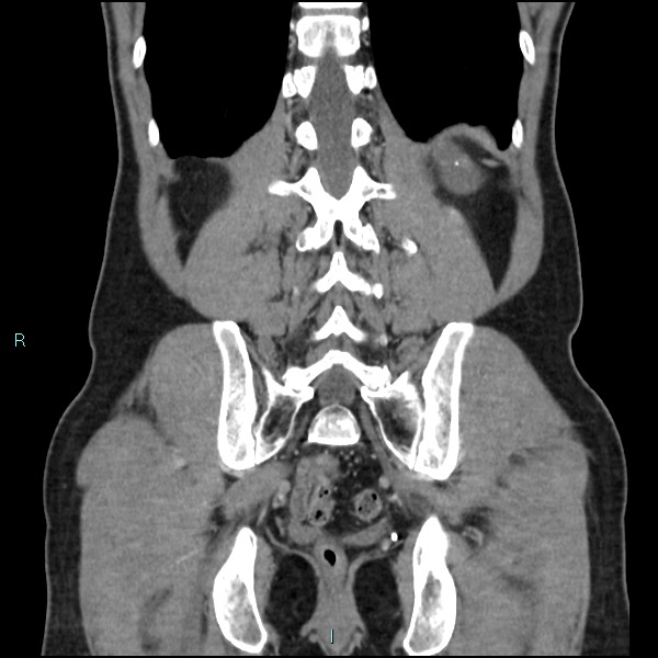 Adrenal cystic lymphangioma (Radiopaedia 83161-97534 Coronal C+ portal venous phase 59).jpg