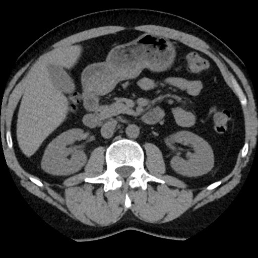 File:Adrenal gland trauma (Radiopaedia 81351-95079 Axial non-contrast 46).jpg