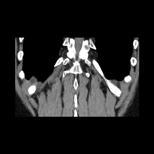 Adrenal gland trauma (Radiopaedia 81351-95079 Coronal non-contrast 76).jpg