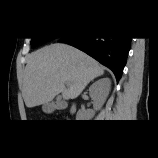 Adrenal gland trauma (Radiopaedia 81351-95079 Sagittal non-contrast 34).jpg