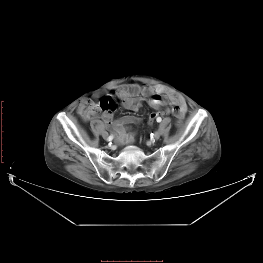 Adrenal hemangioma (Radiopaedia 68923-78668 Axial C+ portal venous phase 55).jpg
