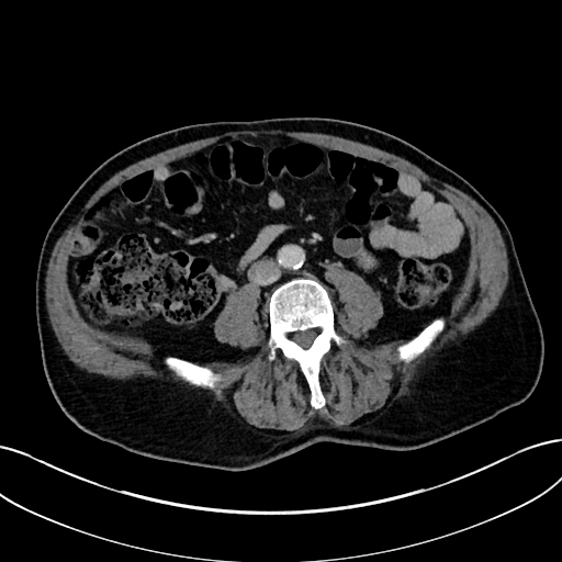 Adrenal lymphoma (Radiopaedia 73730-84529 Axial C+ portal venous phase 73).jpg