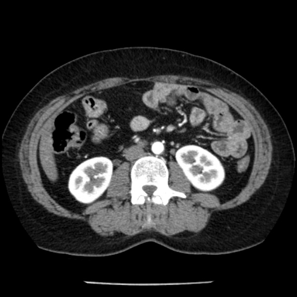 Adrenal myelolipoma (Radiopaedia 43401-46759 Axial C+ arterial phase 52).jpg