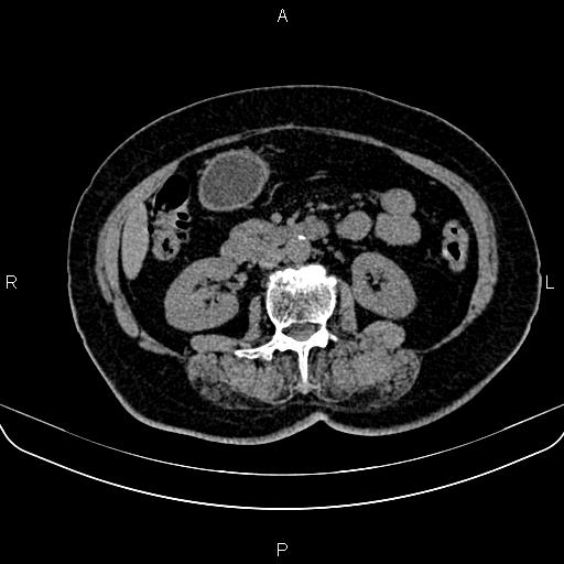 Adrenal myelolipoma (Radiopaedia 82742-96986 Axial non-contrast 75).jpg