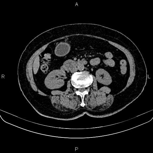 Adrenal myelolipoma (Radiopaedia 82742-96986 Axial non-contrast 77).jpg