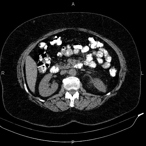 Adrenal myelolipoma (Radiopaedia 84319-99617 Axial With oral contrast 92).jpg