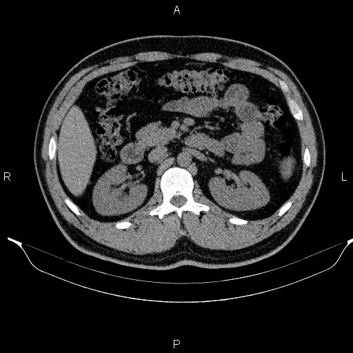 Adrenal myelolipoma (Radiopaedia 84321-99619 Axial non-contrast 44).jpg