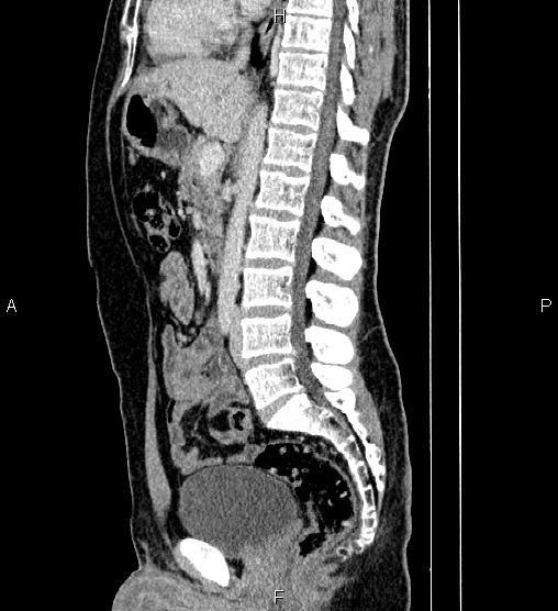 Adrenal myelolipoma (Radiopaedia 87794-104246 Sagittal renal cortical phase 47).jpg