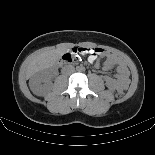 Adrenal myelolipoma - bilateral (Radiopaedia 74805-85810 Axial non-contrast 41).jpg