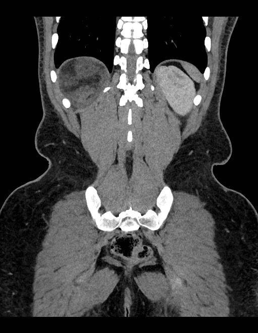 Adrenal myelolipoma - bilateral (Radiopaedia 74805-85810 Coronal C+ portal venous phase 76).jpg