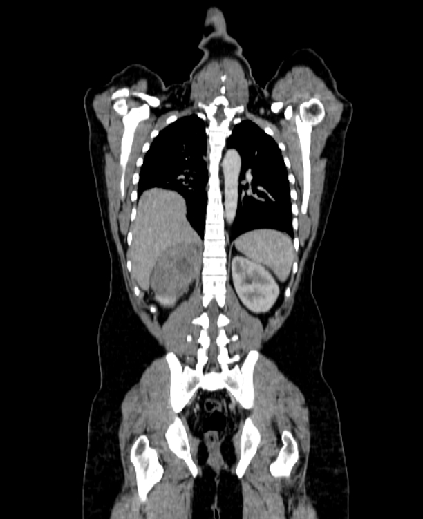 Adrenocortical carcinoma (Radiopaedia 80134-93438 Coronal C+ portal venous phase 118).jpg