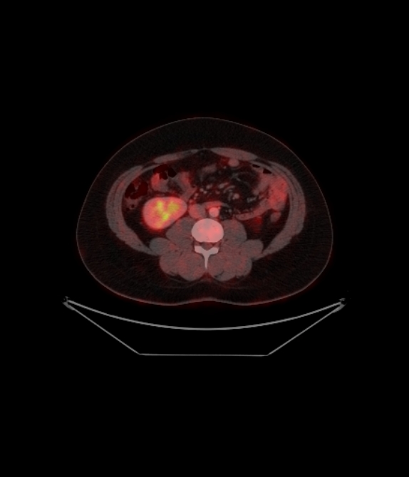 Adrenocortical carcinoma (Radiopaedia 80134-93440 ِAxial 192).jpg