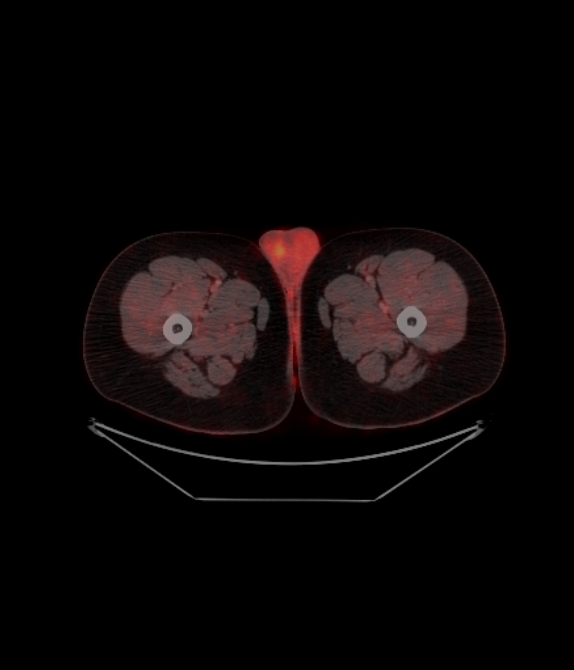 Adrenocortical carcinoma (Radiopaedia 80134-93440 ِAxial 285).jpg