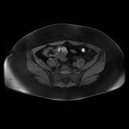 File:Adult granulosa cell tumor of the ovary (Radiopaedia 64991-73953 axial-T1 Fat sat post-contrast dynamic 3).jpg