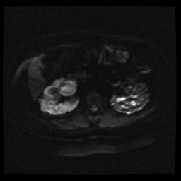 Adult polycystic kidney disease (Radiopaedia 59075-66365 Axial DWI 18).jpg