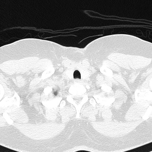File:Air trapping in small airway disease (Radiopaedia 61685-69694 Axial lung window 7).jpg