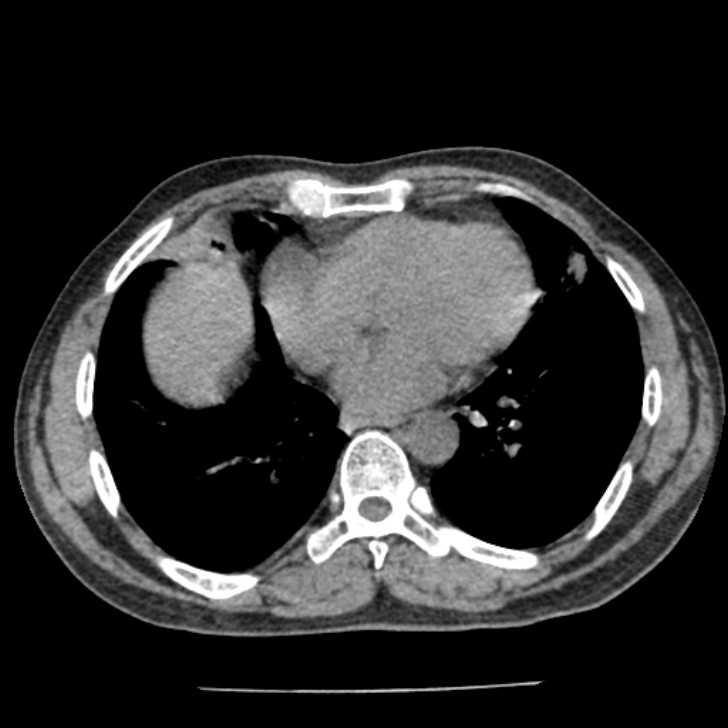 Airway foreign body in adult (Radiopaedia 85907-101779 Axial liver window 124).jpg