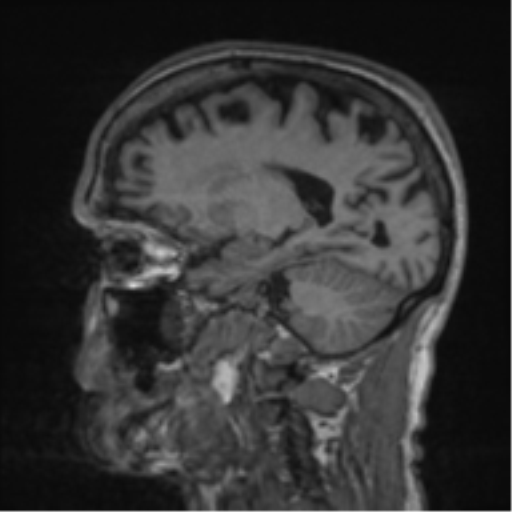 File:Alzheimer's disease- with apraxia (Radiopaedia 54763-61011 Sagittal T1 46).png