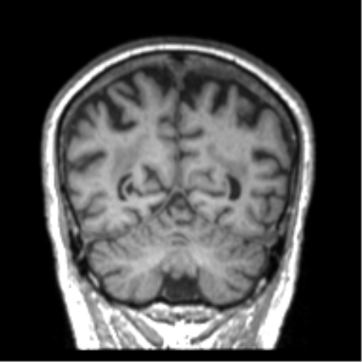 Alzheimer disease and cerebral amyloid angiopathy (Radiopaedia 64234-73011 Coronal T1 10).png