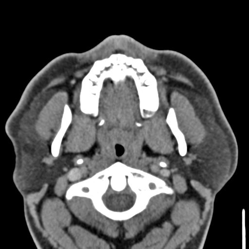File:Ameloblastoma (Radiopaedia 33677-34806 Axial non-contrast 13).png