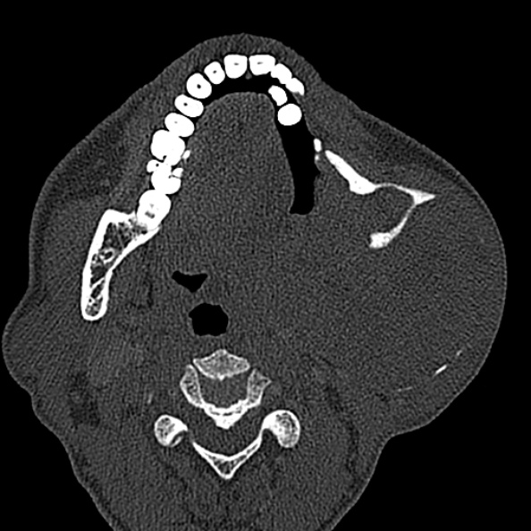 Ameloblastoma (Radiopaedia 51921-57766 Axial bone window 77).jpg