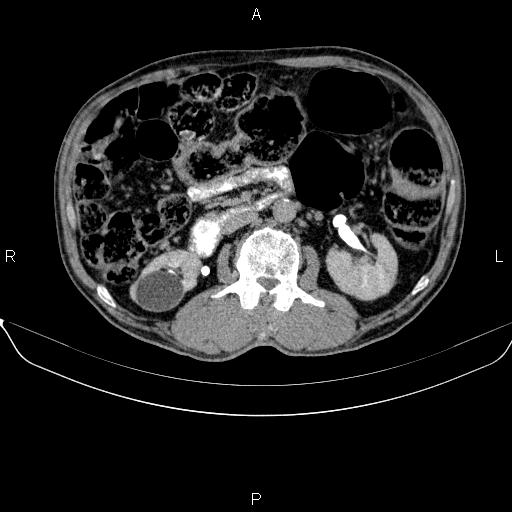 Ampullary adenocarcinoma (Radiopaedia 86093-102032 Axial C+ delayed 47).jpg