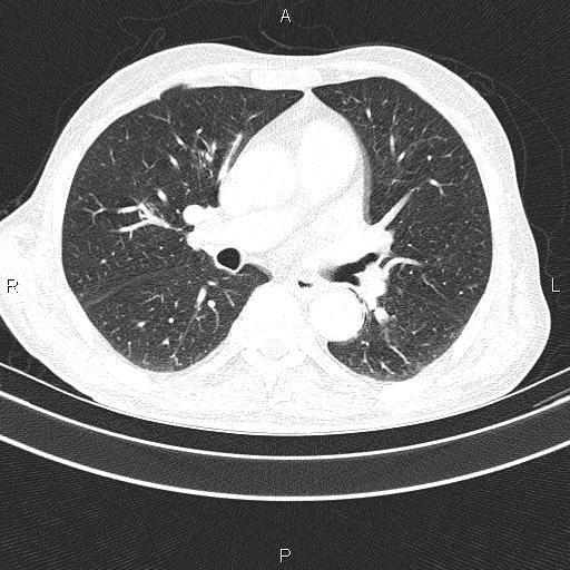 Ampullary adenocarcinoma (Radiopaedia 86093-102033 Axial lung window 32).jpg