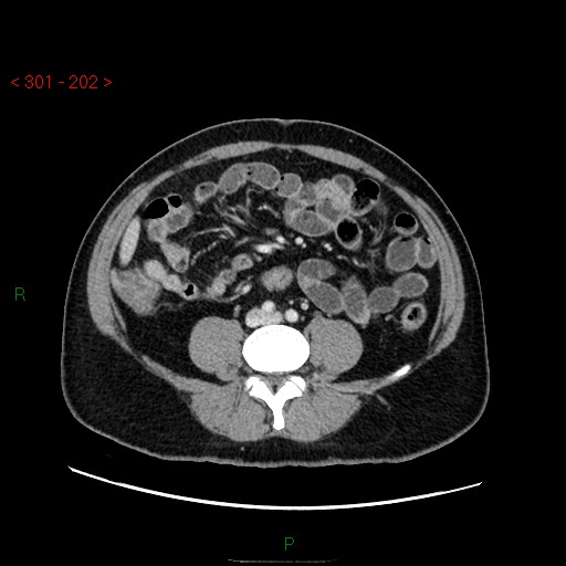 File:Ampullary carcinoma (Radiopaedia 56396-63056 C 62).jpg