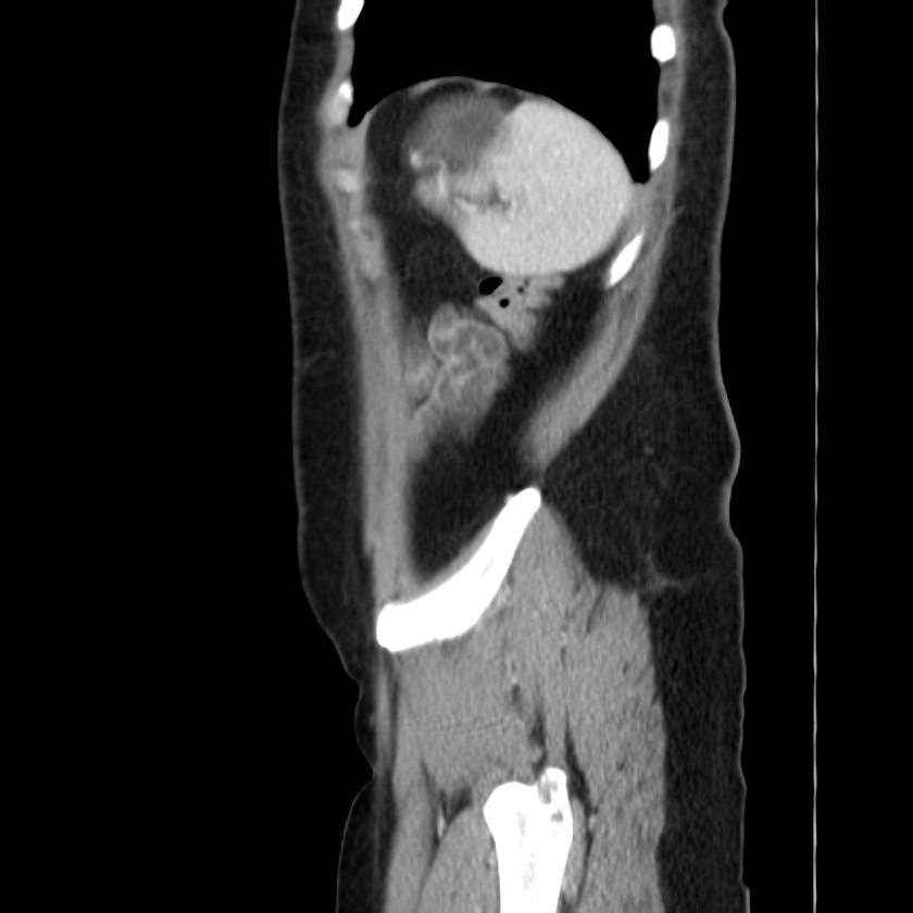 Ampullary tumor (Radiopaedia 22787-22816 D 49).jpg