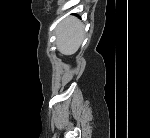 File:Ampullary tumor (Radiopaedia 60333-67998 C 2).jpg