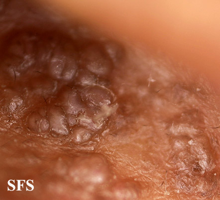 Amyloidosis (Dermatology Atlas 8).jpg