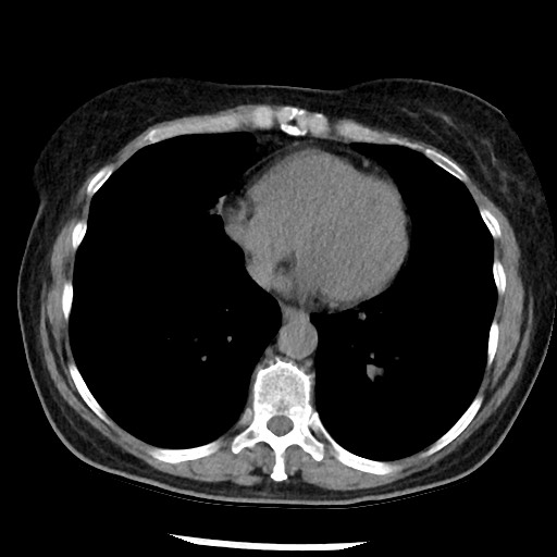 Amyloidosis - bronchial and diffuse nodular pulmonary involvement (Radiopaedia 60156-67744 Axial non-contrast 39).jpg