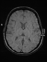 Amyotrophic lateral sclerosis (Radiopaedia 70821-81017 Axial SWI 28).jpg