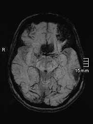 File:Amyotrophic lateral sclerosis (Radiopaedia 70821-81017 Axial SWI minIP 17).jpg