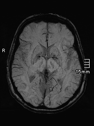 File:Amyotrophic lateral sclerosis (Radiopaedia 70821-81017 Axial SWI minIP 21).jpg