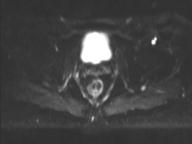 File:Anal adenocarcinoma - tumor regression grade 1 (Radiopaedia 31358-32100 Axial DWI 17).jpg