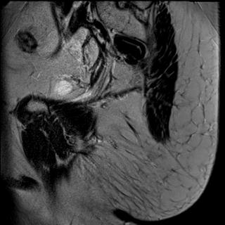 File:Anal adenocarcinoma - tumor regression grade 1 (Radiopaedia 31358-32100 Sagittal T2 1).jpg