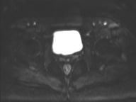 File:Anal adenocarcinoma - tumor regression grade 1 (Radiopaedia 31358-32101 Axial DWI 14).jpg