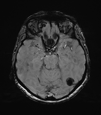 Anaplastic astrocytoma (Radiopaedia 86943-103160 Axial SWI 36).png